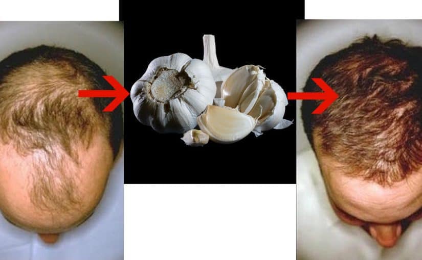 d8b7d8b1d98ad982d8a9-d8a7d8b3d8aad8aed8afd8a7d985-d8a7d984d8abd988d985-d984d8a5d986d8a8d8a7d8aa-d8a7d984d8b4d8b9d8b1-825x510-2 طريقة استخدام الثوم لإنبات الشعر