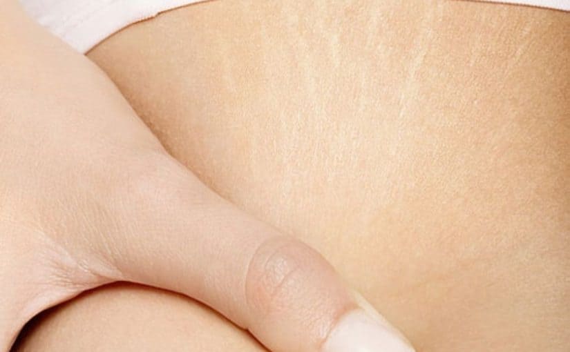 d8b9d984d8a7d8ac-d8a7d984d8aed8b7d988d8b7-d988d8aad8b1d987d984d8a7d8aa-d8a8d8a7d984d8acd8b3d985-825x510-2 علاج الخطوط وترهلات بالجسم