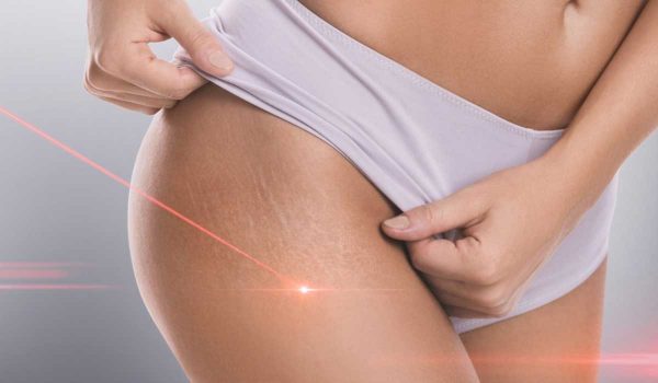 علاج السيلوليت بالليزر Cellulaze