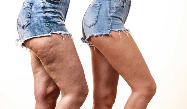 علاج السيلوليت