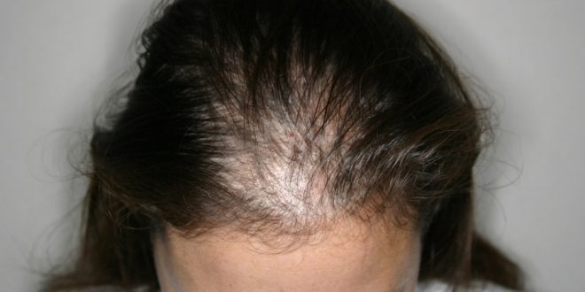 علاج الصلع الأمامي عند النساء