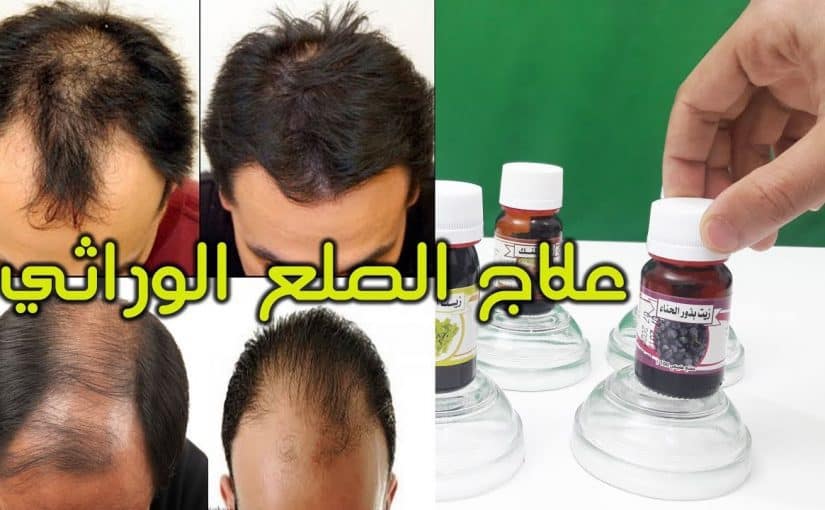 علاج الصلع المبكر