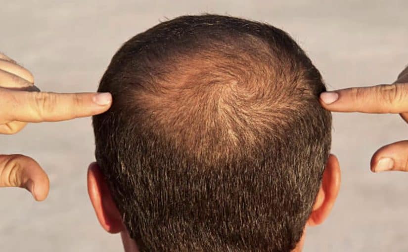 d8b9d984d8a7d8ac-d8a7d984d8b5d984d8b9-d8a7d984d988d8b1d8a7d8abd98a-825x510-2 علاج الصلع الوراثي