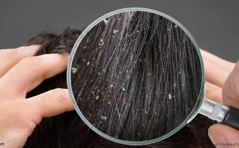 d8b9d984d8a7d8ac-d8a7d984d982d8b4d8b1d8a9-825x510-2 علاج القشرة