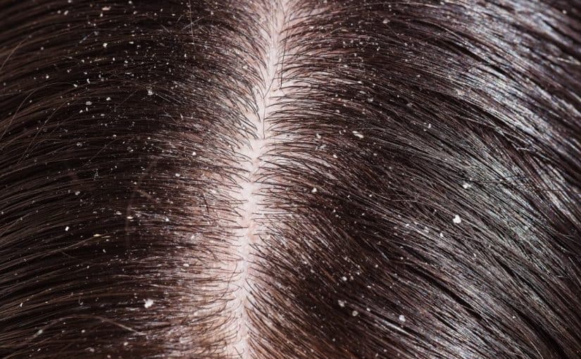 d8b9d984d8a7d8ac-d8a7d984d982d8b4d8b1d8a9-825x510-3 علاج القشرة