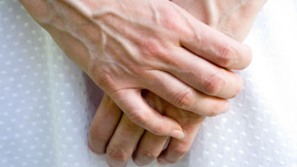 علاج-بروز-عروق-اليدين