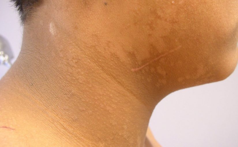 d8b9d984d8a7d8ac-d8b3d988d8a7d8af-d8a7d984d8b1d982d8a8d8a9-d984d984d8b1d8acd8a7d984-825x510-2 علاج سواد الرقبة للرجال