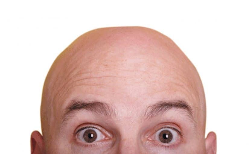 علاج صلع مقدمة الرأس عند الرجال