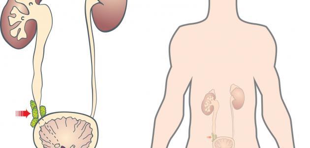 علاج احتقان البروستاتا بالاعشاب