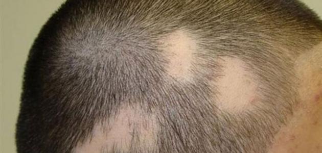 علاج الثعلبة بالثوم