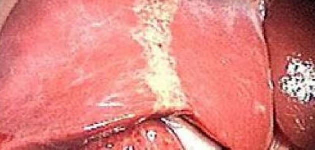 علاج دهون الكبد بالاعشاب