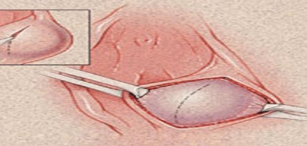 علاج غدة بارثولين