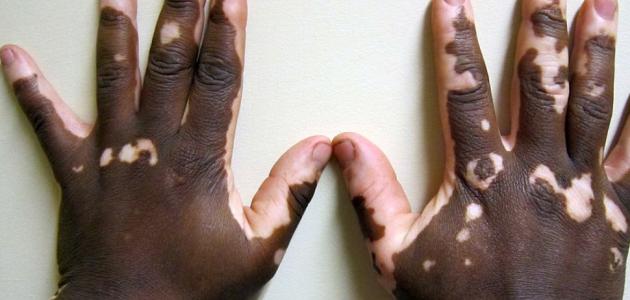 علاج مرض البهاق بالاعشاب