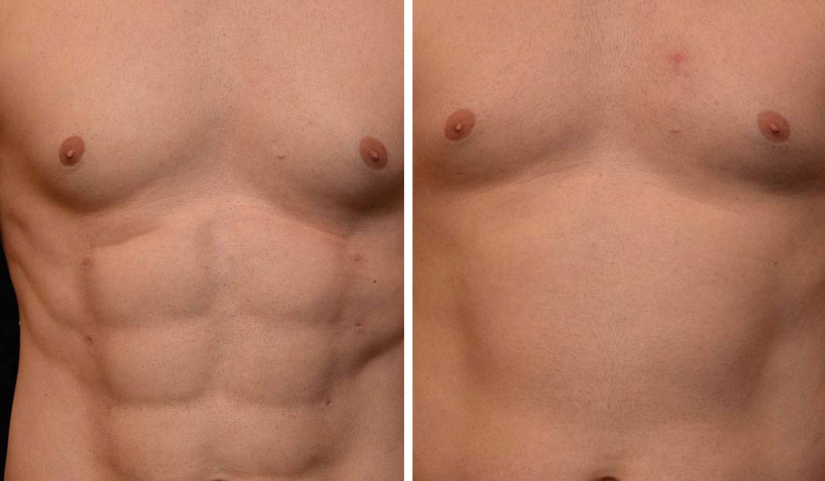 عمليات نحت الجسم قبل وبعد