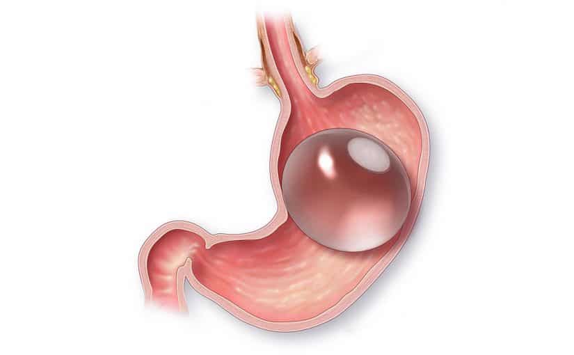 d8b9d985d984d98ad8a9-d8a8d8a7d984d988d986-d8a7d984d985d8b9d8afd8a9-825x510-2 تجارب بالون المعدة فوائد واضرار