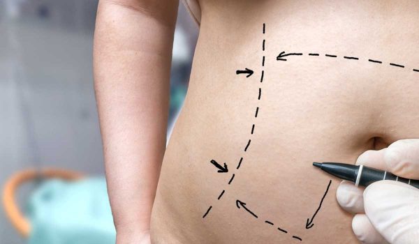 عملية شد البطن بالليزر