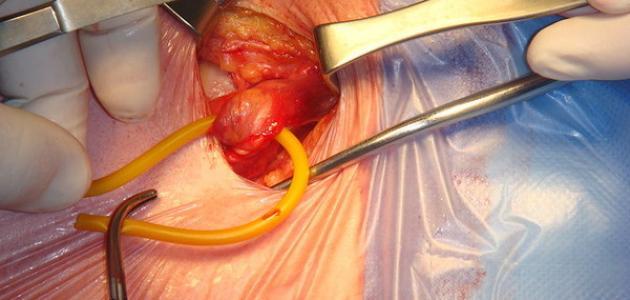 عملية الفتاق