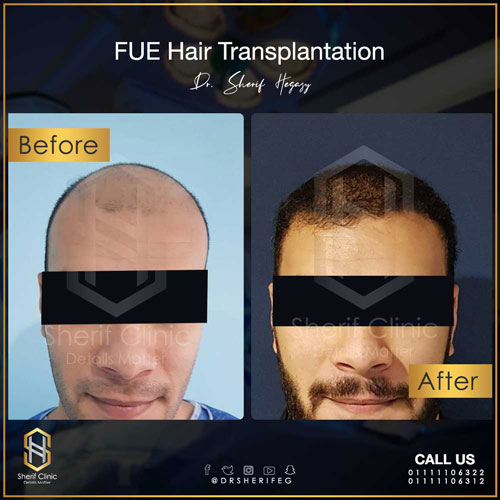 قبل-وبعد-زراعة-الشعر2