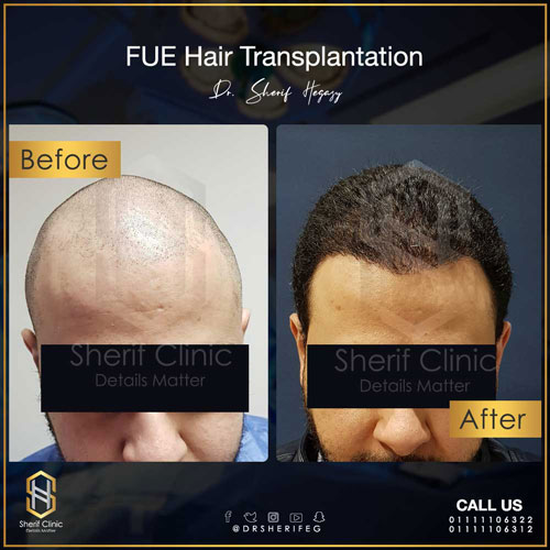 قبل-وبعد-زراعة-الشعر3