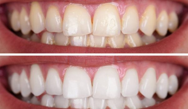 قشرة الأسنان قبل وبعد
