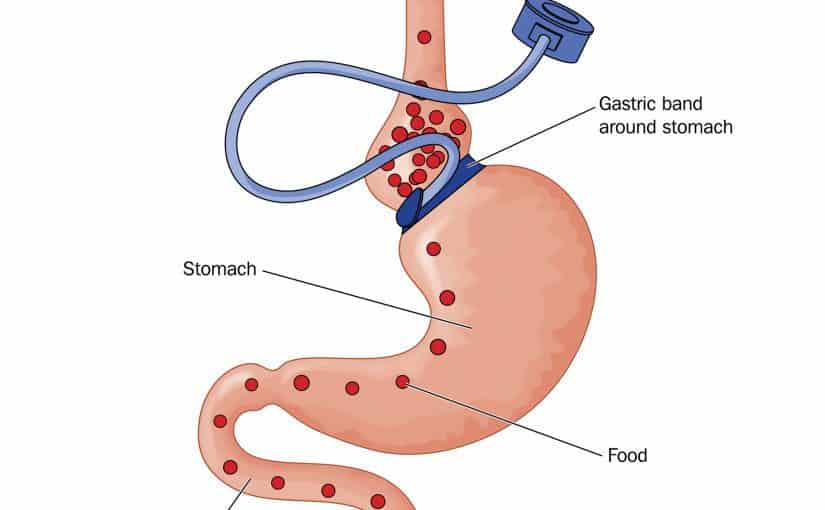 d983d8b1d985d8b4d8a9-d8a7d984d985d8b9d8afd8a9-825x510-2 تكلفة عملية كرمشة المعدة في السعودية