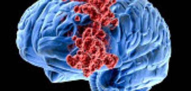 ما اعراض ورم الراس