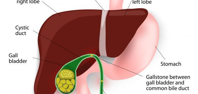 ما هو علاج حصوة المرارة بالاعشاب