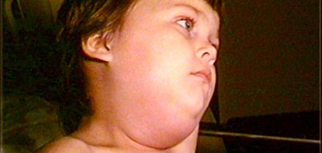 ما هو مرض ابو كعب