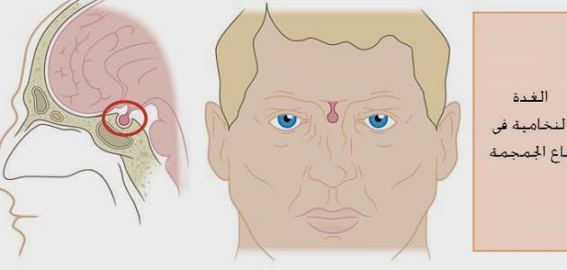 ما هى اعراض ورم الغدة النخامية