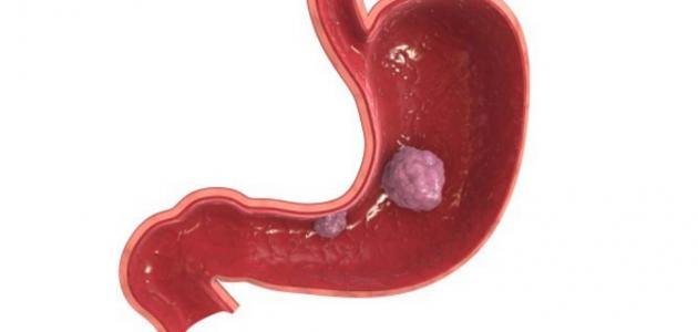 ما هي أعراض مرض سرطان المعدة