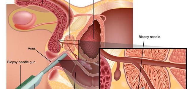 ماهو علاج البروستاتا بالاعشاب