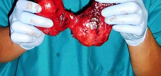 متى يتم استئصال الغدة الدرقية