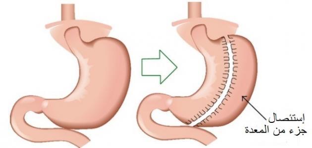 مخاطر عملية التكميم