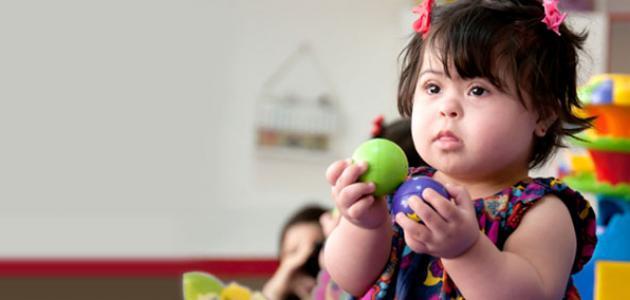 مظاهر متلازمة داون