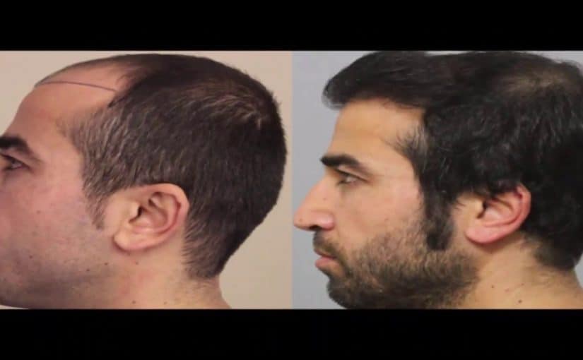 d985d8b9d984d988d985d8a7d8aa-d8b9d986-d8afd983d8aad988d8b1-d985d8add985d8af-d8acd988d8aad8b4d984d988-d981d98a-d8b2d8b1d8a7d8b9d8a9-d8a7d984d8b4d8b9d8b1-d8a8d8aad8b1d983d98ad8a7-825x510-2 معلومات عن دكتور محمد جوتشلو في زراعة الشعر بتركيا