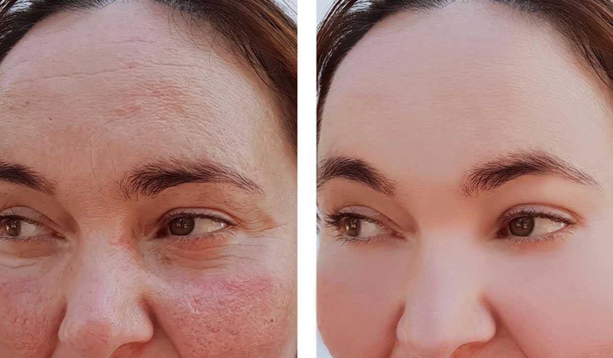 نتائج تقشير الوجه بالليزر قبل وبعد