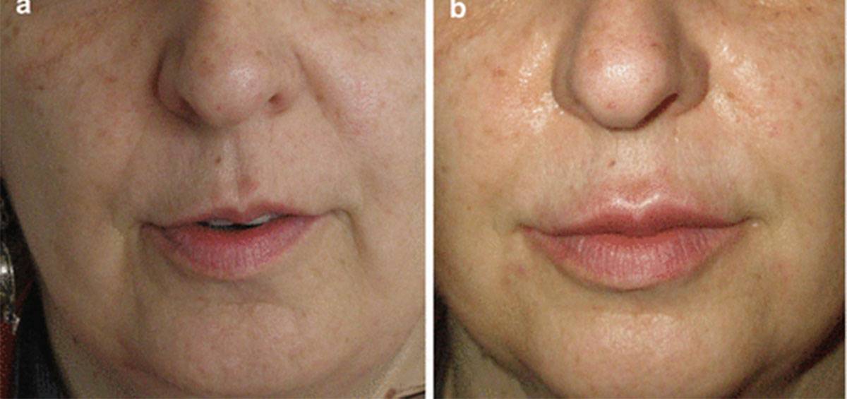 نتائج حقن البلازما للشفايف