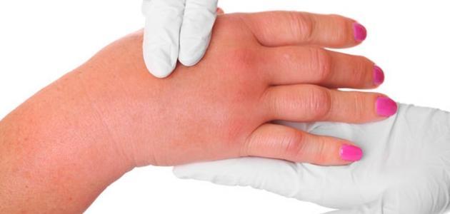 هرمون الفازوبريسين