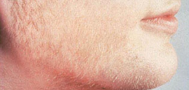 هرمون اندروجين