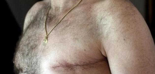 هل يصيب سرطان الثدي للرجال