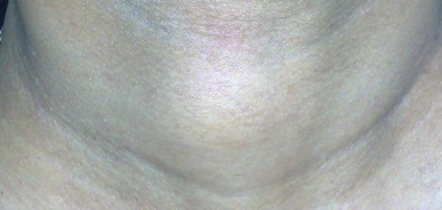 ورم خبيث في الغدة الدرقية