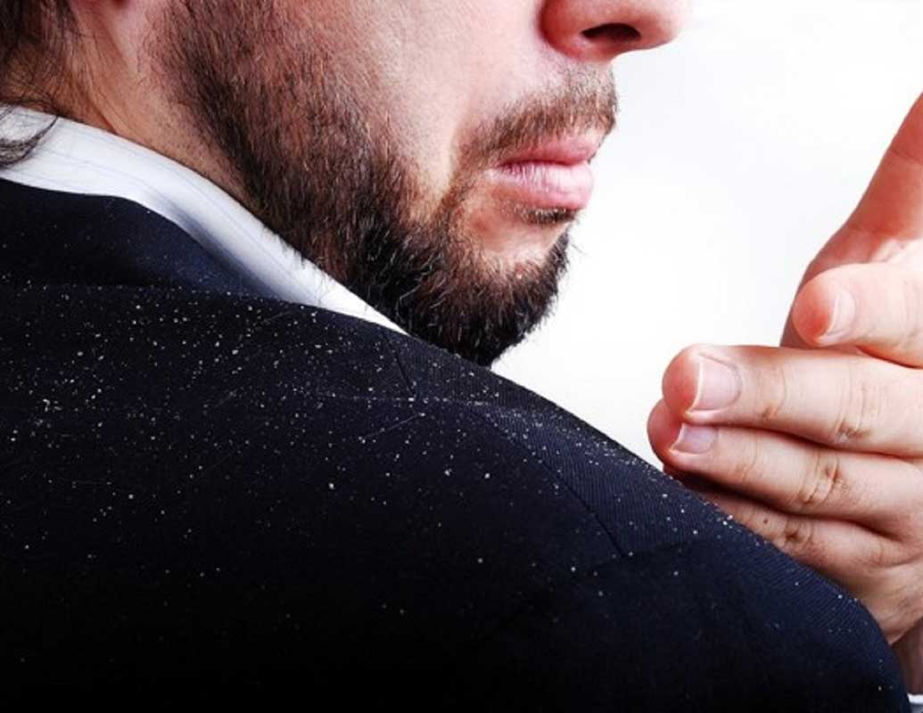 قشرة الشعر – أسباب حدوثها وطرق التخلص منها بالطرق الطبيعية
