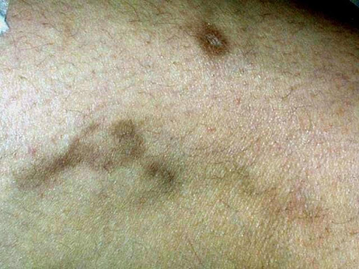 de55161039b9d331e2d2279b3b6d8941 الآثار الجانبية لعلاج الدوالي بالليزر