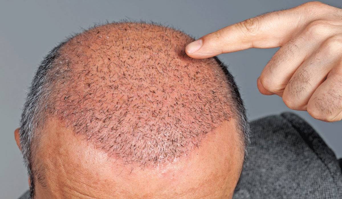 زراعة الشعر للرجال