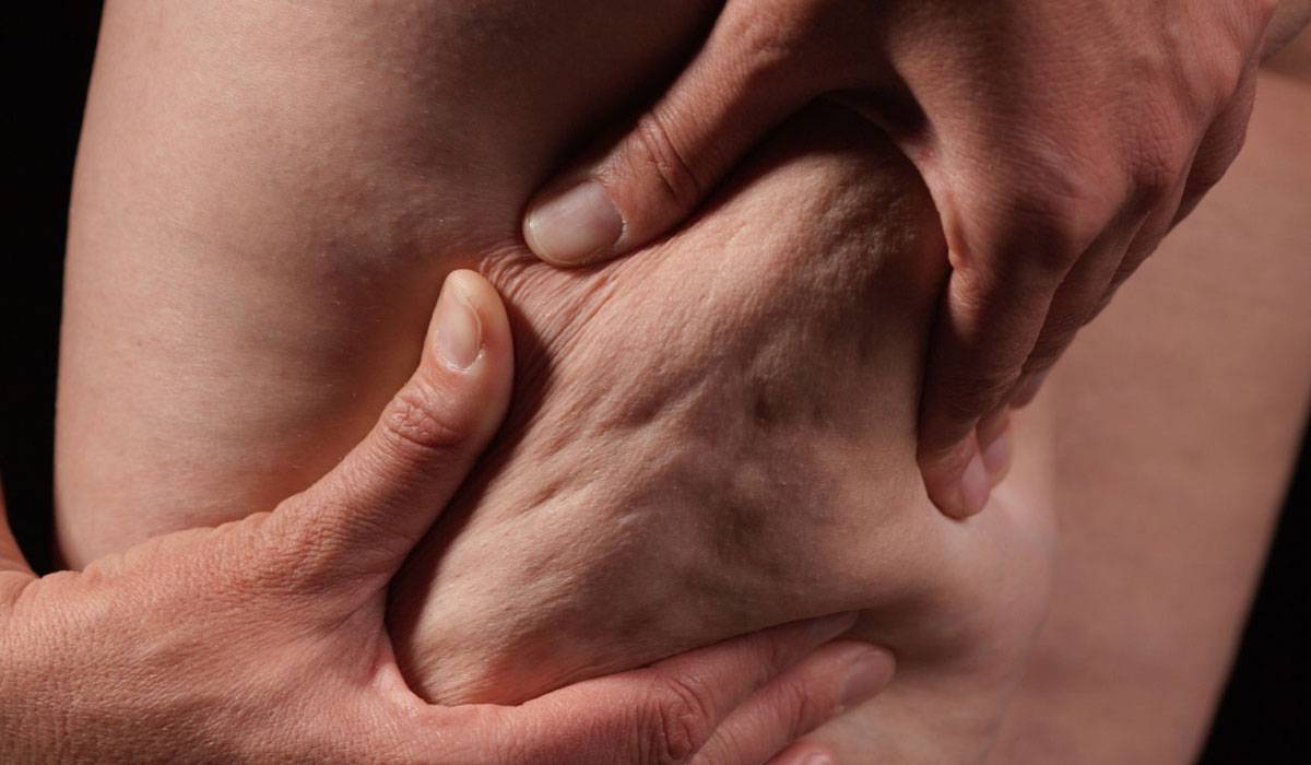 ازالة السيلوليت بالليزر