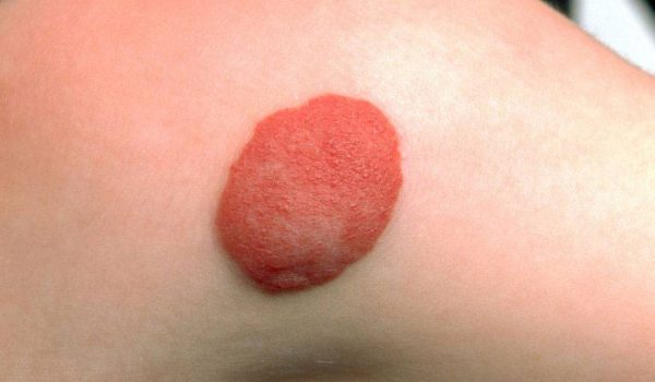 وحمة وعائية أو شكل الفراولة