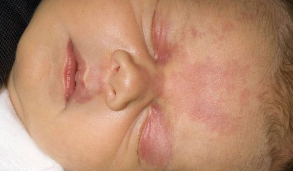 وحمة بقع السلمون