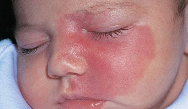 الوحمة الدموية النبيذية ( PORT WINE STAIN)