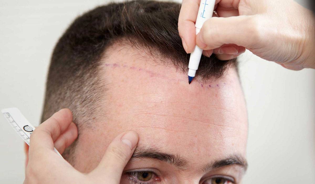 عملية زراعة الشعر