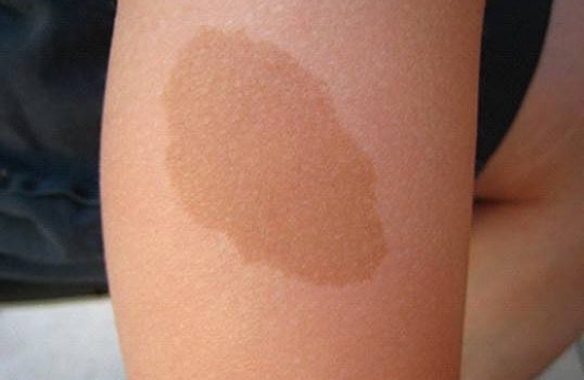 وحمة بقع القهوة بالحليب